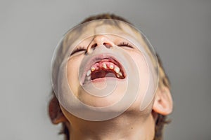 Abnormal boy tooth. The extra narrow strange tooth grew in the boy`s mouth. Boy shows his crooked tooth. Patient