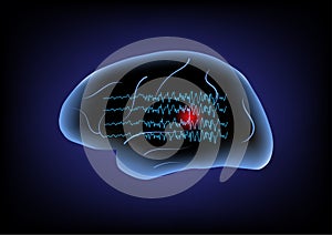 Abnormal brain waves and human brain