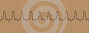 Abnormal cardiogram ventricular tachycardia