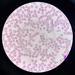 Abnormal cell macro ovalocyte