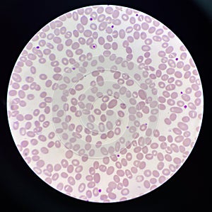 Abnormal cell macro ovalocyte