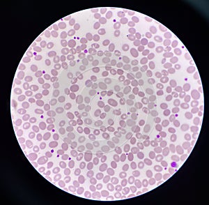 Abnormal cell macro ovalocyte