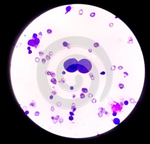 Abnormal cells in pleural fluid