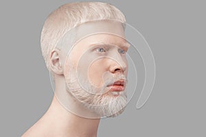 Abnormal deviations concept. Albino man with pale skin and white hair looking aside over grey studio background