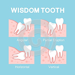 Abnormal eruption of wisdom tooth. Dental problems