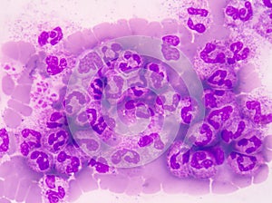 Abnormal neutrophil in pleural fluid smear