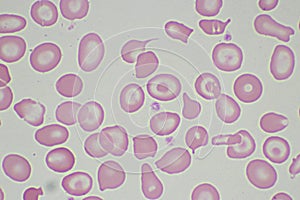 Abnormal red blood cells