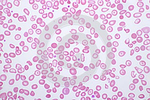 Abnormal red blood cells