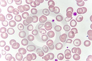 Abnormal red blood cells from anemia patient photo