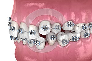 Abnormal teeth position and metal braces tretament. Medically accurate dental 3D illustration