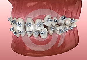 Anormale denti posizione un metallo bretelle. dal punto di vista medico accurato dentale illustrazioni 