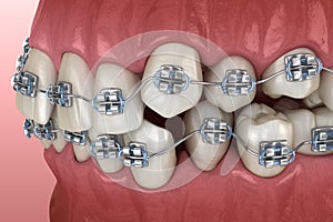 Anormale denti posizione un metallo bretelle. dal punto di vista medico accurato dentale illustrazioni 