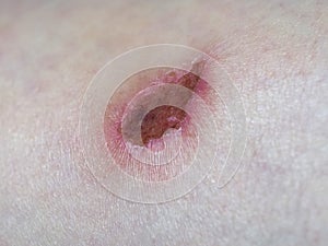 abrasion scar tissue