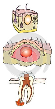 Abscess photo