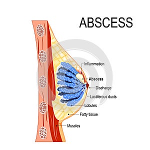 Abscess. Cross-section of the mammary gland with inflammation photo