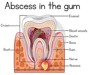 Abscess in the Gum Diagram photo