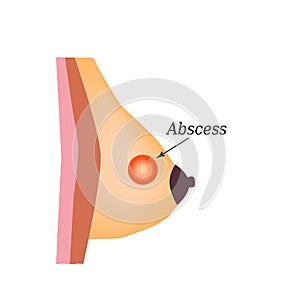 Abscess in the mammary gland. World Breast Cancer Day. Vector illustration on isolated background