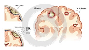 Abscess set vector
