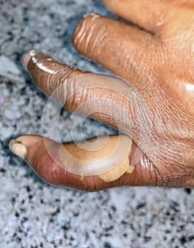 Abscess with surrounding cellulitis or Staphylococcal skin infection at little finger of left hand in Southeast Asian Burmese man. photo
