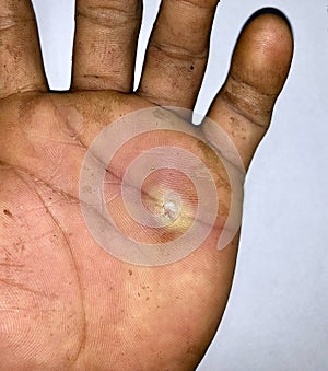 Abscess with surrounding cellulitis or Staphylococcal, Streptococcal skin infection at hand of Asian Burmese patient photo