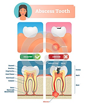 Abscess tooth vector illustration. Labeled medical diagram with structure. photo