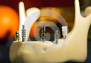 Abutments in the artificial jawbone