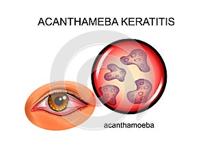 Acanthameba keratitis. conjunctivitis photo