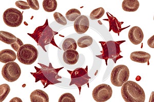 Acanthocytes, abnormal red blood cells with thorn-like projections