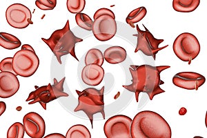 Acanthocytes, abnormal red blood cells with thorn-like projections