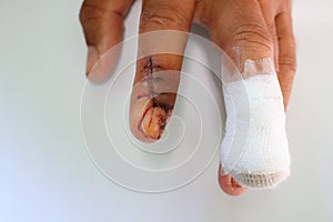 Accidental wounds At the fingers Fingernails, nails, stitches and cure