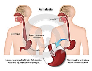 Achalasia of the esophagus 3d medical  illustration