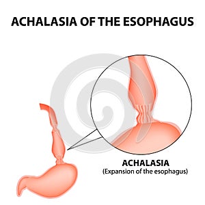 Achalasia of the esophagus. Expansion of the esophagus. Hernia. Infographics. Vector illustration on isolated background