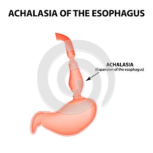 Achalasia of the esophagus. Expansion of the esophagus. Hernia. Infographics. Vector illustration on isolated background photo