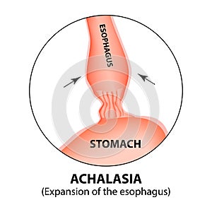 Achalasia of the esophagus. Expansion of the esophagus. Hernia. Infographics. Vector illustration on isolated background photo