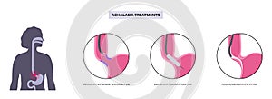 Achalasia treatments procedures
