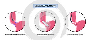 Achalasia treatments procedures photo