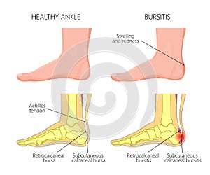 Achilles bursitis