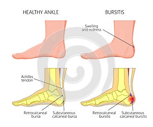 Achilles bursitis photo