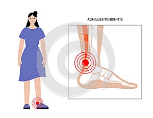 Achilles tendon injury