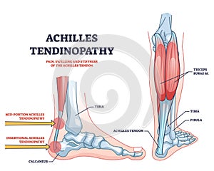 Achilles tendinopathy as injury to tendon in human heel outline diagram photo