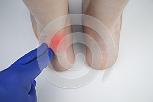 An orthopedic doctor examines a woman`s leg. Achilles tendon and ankle diseases. Inflammation of the heel and foot, photo