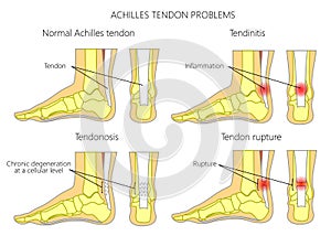 Achilles tendon injures photo