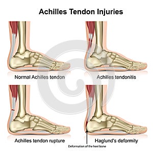 Achilles tendon injures medical vector illustration isolated on white background with english description photo