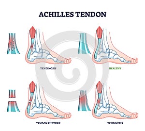 Achilles tendon injury types as leg or ankle trauma examples outline diagram photo