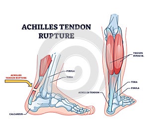 Achilles tendon rupture as painful injury and leg trauma outline diagram