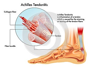 Achilles Tendonitis photo