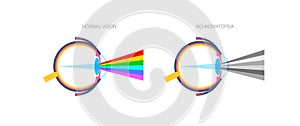 Achromatopsia vision deficiency