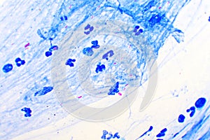 Acid-fast bacilli positive in sputum smear photo