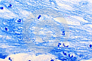Acid-fast bacilli positive in sputum smear photo