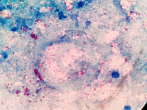 Acid-fast bacilli. Ziehl Neelsen stain